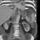 Aneurysm of lienal artery: CT - Computed tomography
